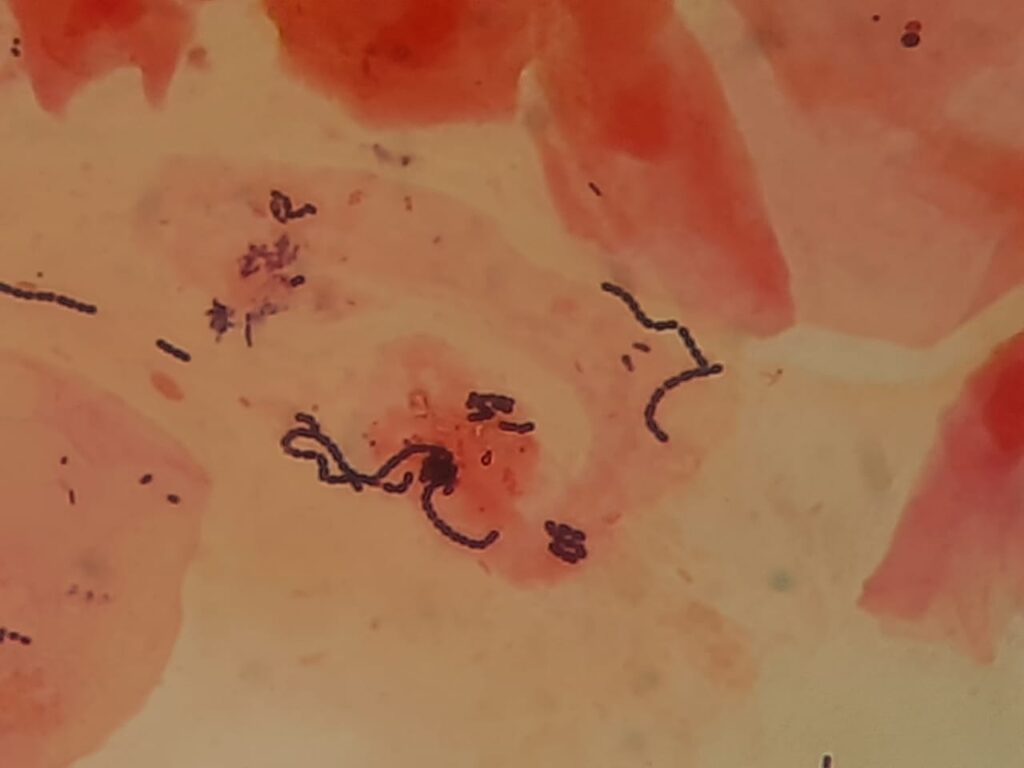 Mixed flora of Gram-positive and Gram-negative bacteria and epithelial cells in throat swab Gram stain microscopy at a magnification of 4000X