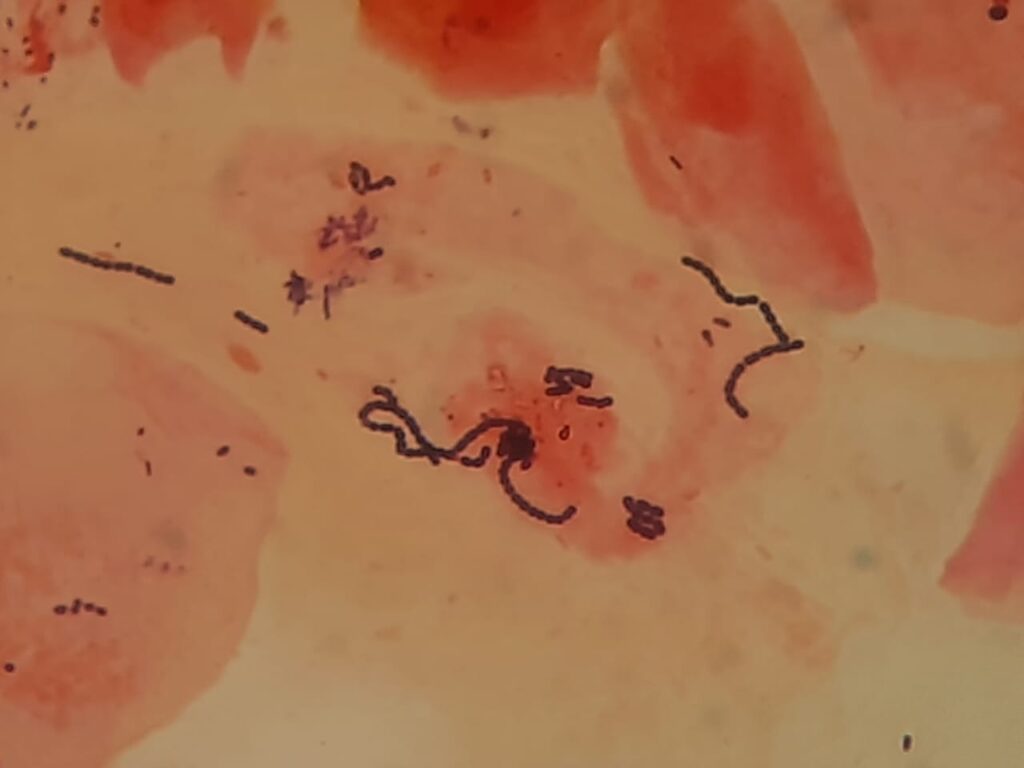 Mixed flora of Gram-positive cocci and Gram-negative cocci or rods and epithelial cells in throat swab Gram stain microscopy at a magnification of 4000X