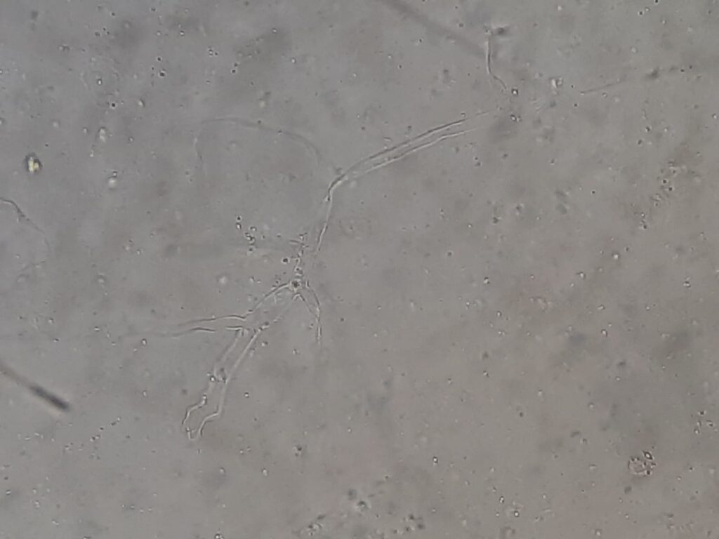 Septate acute-angled branching hyphae of Aspergillus in KOH mount of sputum