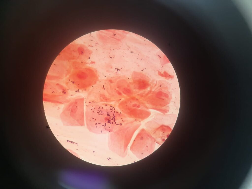 Throat swab Gram stain photomicrograph at a magnification of 1000X