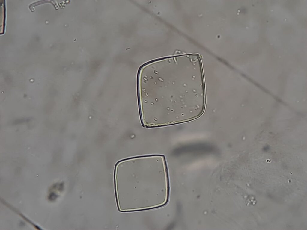 Uric acid crystals in urinary sediment microscopic examination at a magnification of 1600X showing daimond form