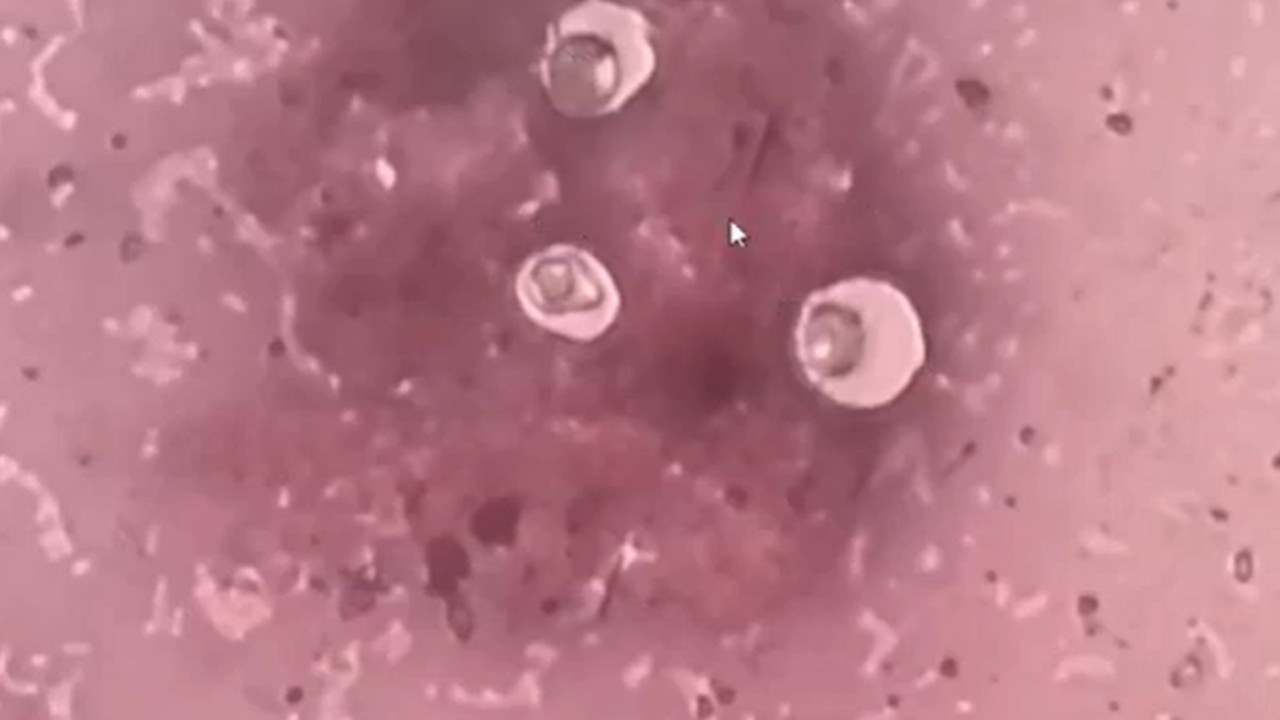 Direct Microscopy-India Ink smear showing encapsulated yeast cells