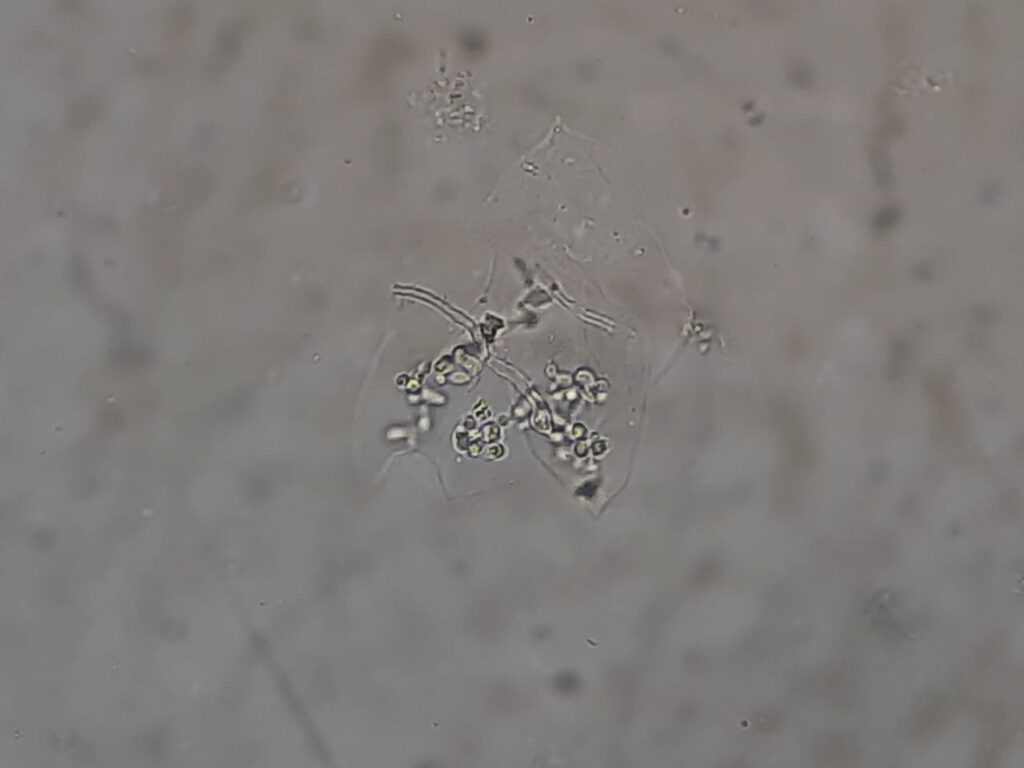 Fungal Elements in KOH Mount of Sputum