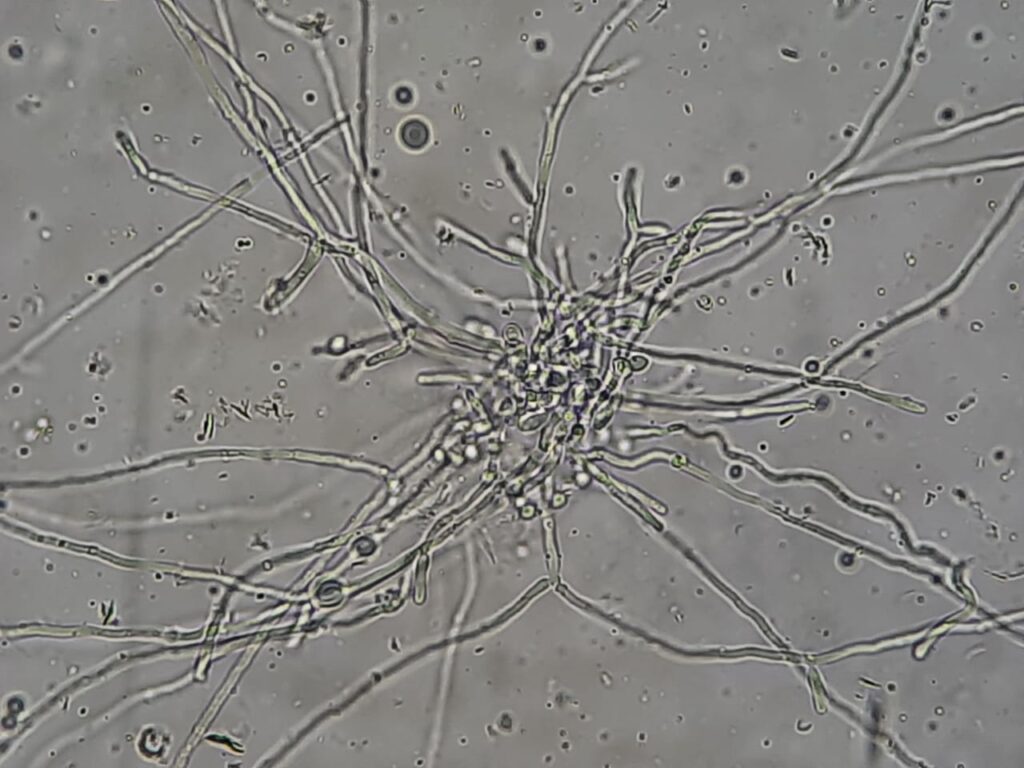 Fungal Elements in KOH Mount of Sputum Microscopy