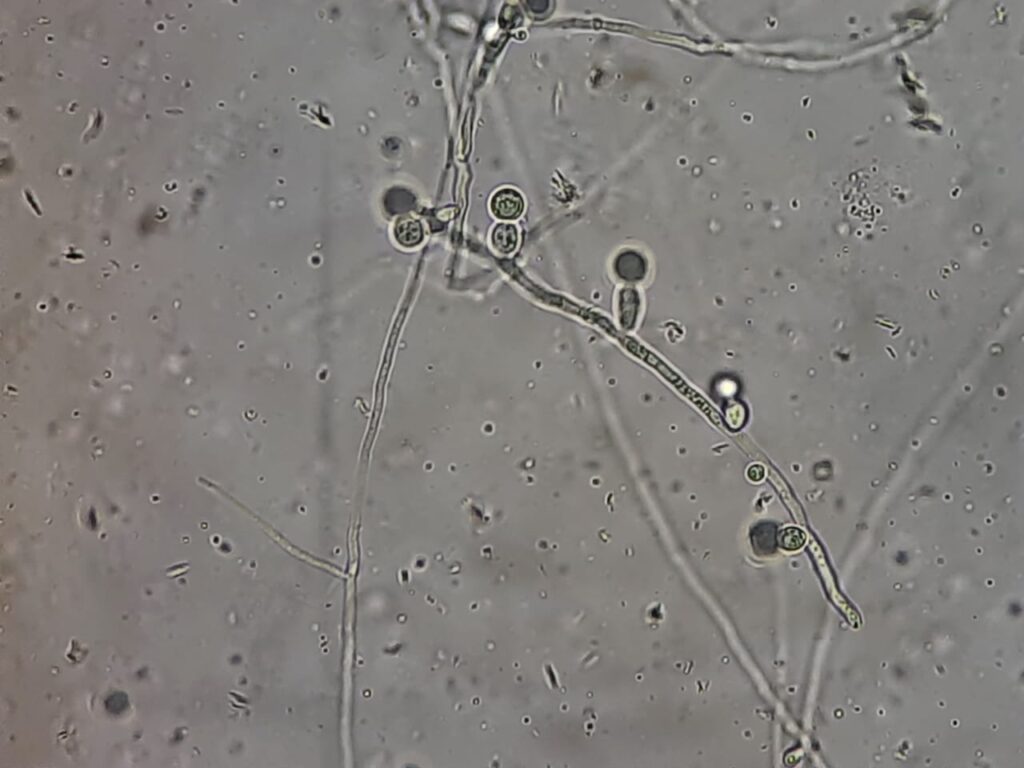 Fungal Elements in KOH Mount of Sputum Microscopy at a magnification of 1600X