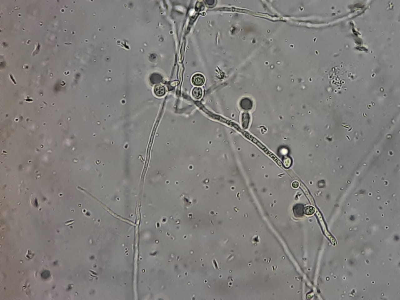 Fungal Elements in KOH Mount of Sputum Microscopy at a magnification of 1600X