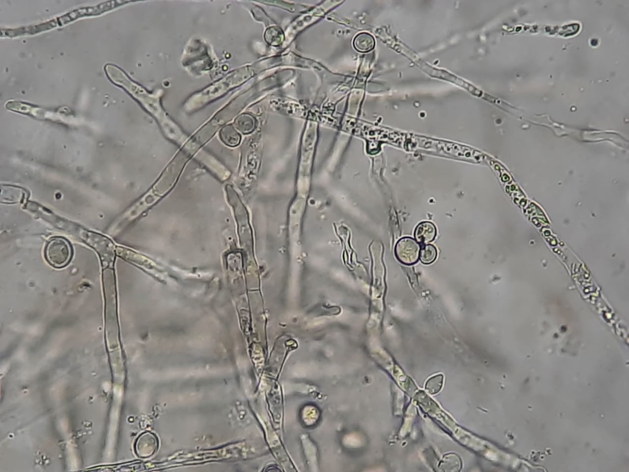 Fungal Elements in wet mount of culture of BAL specimen