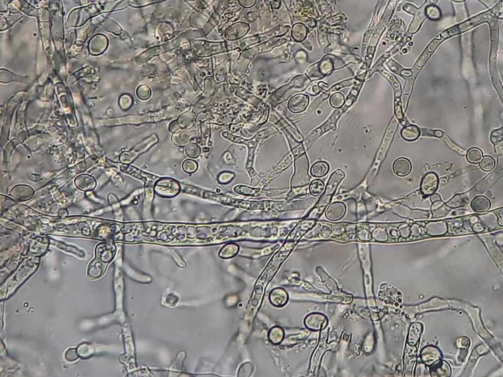 Fungal elements in wet mount of culture of BAL fluid