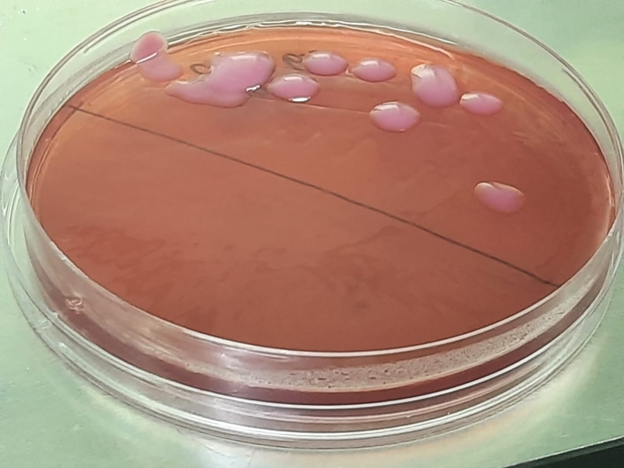 BAL Sample vs Sputum Sample – Key Differences