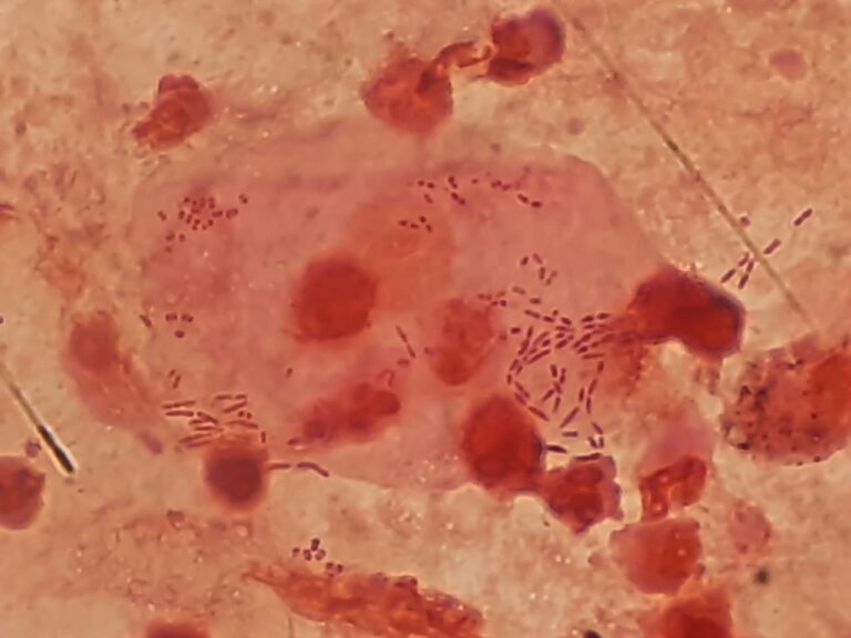 BAL Sample vs Sputum Sample – Key Differences