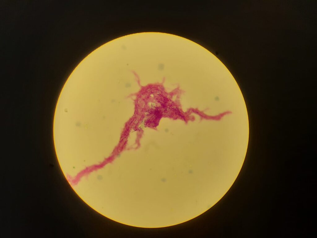 Serpentine cord or Cord factor or Trehalose dimycolate (TDM) of Mycobacterium tuberculosis (MTB) in Ziehl-Neelsen Staining of modified Middlebrook 7H9 Broth at a magnification of 400X