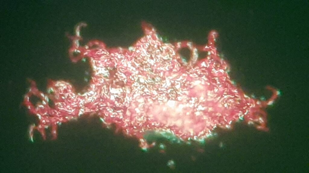 Serpentine cord or Cord factor or Trehalose dimycolate (TDM) of Mycobacterium tuberculosis complex (MTBC) in Auramine-Rhodamine Fluorochrome stained smear microscopy of modified Middlebrook 7H9 Broth