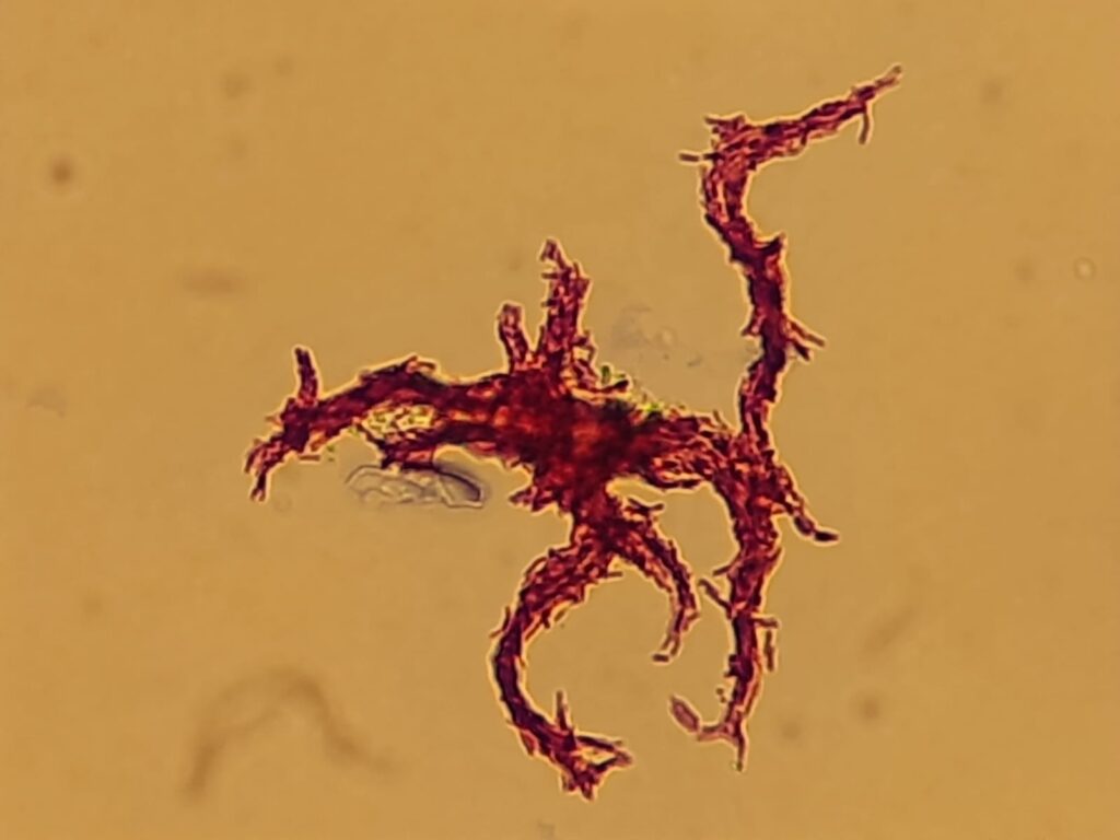 Serpentine cord or Cord factor or Trehalose dimycolate,TDM of Mycobacterium tuberculosis complex (MTBC) in Ziehl-Neelsen Staining of modified Middlebrook 7H9 Broth at a magnification of 1600X