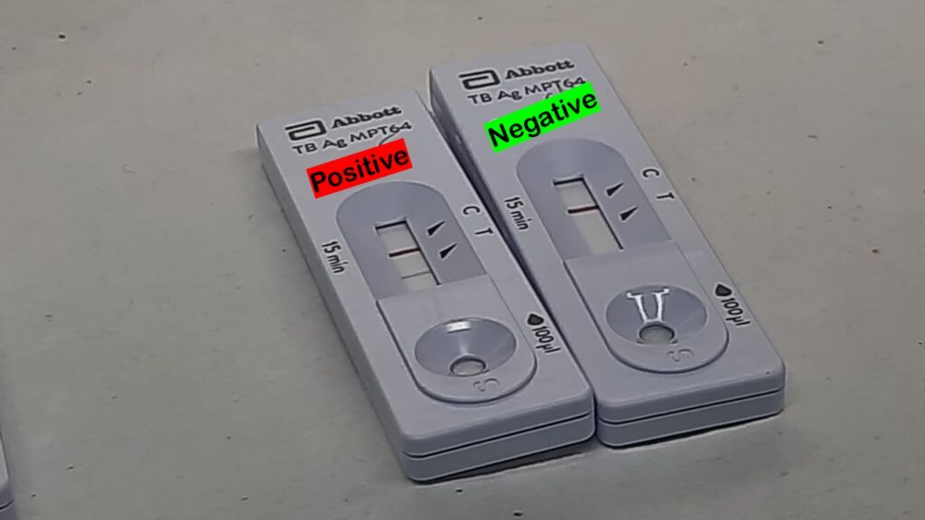 The MPT64 antigen, a protein secreted by Mycobacterium tuberculosis complex (MTBC) during growth, serving as a highly specific biomarker for identifying TB-Positive test (left) and negative (right device) as shown in this photograph
