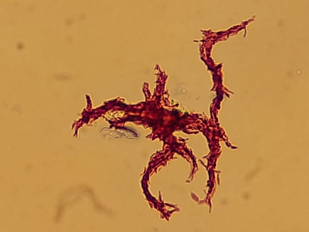 Ziehl-Neelsen stain showing the diagnostic serpentine cording of Mycobacterium tuberculosis complex acid-fast bacilli from MGIT culture.
