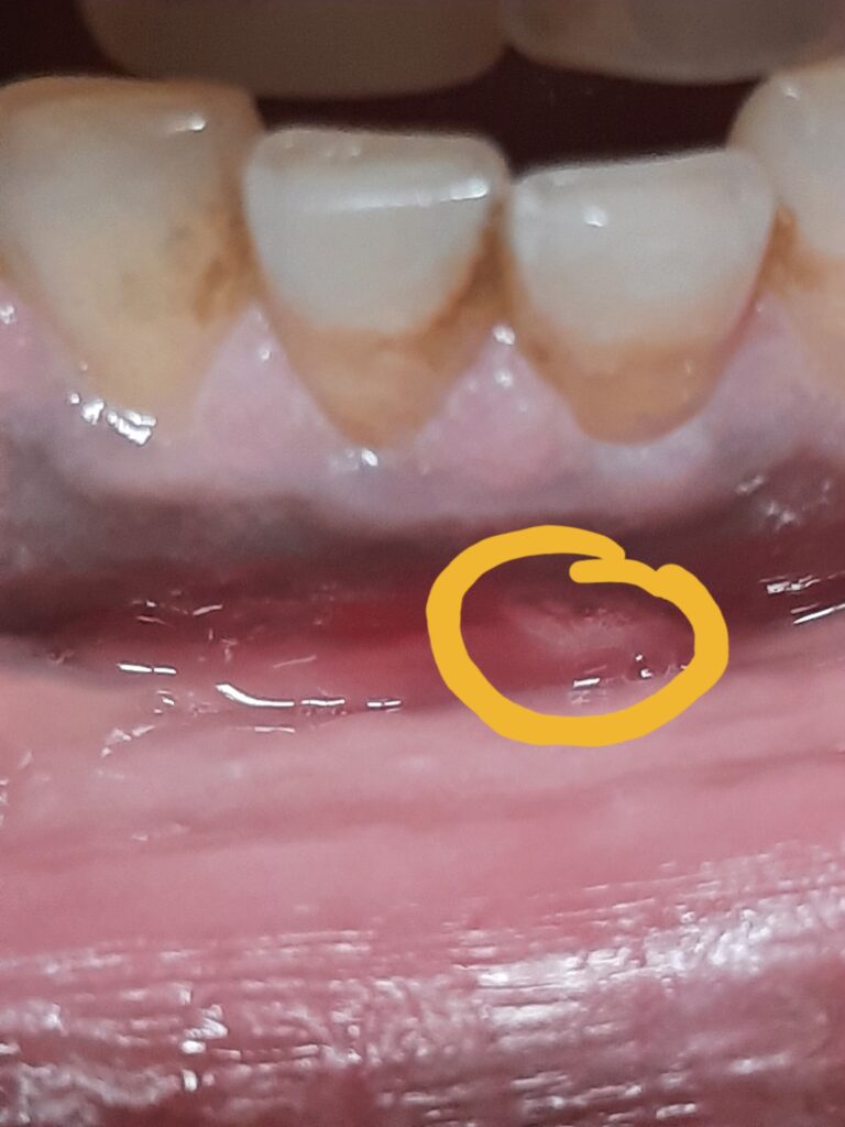 a red, oval lesion on the inner lower lip with a small white center, surrounded by an area of inflammation.