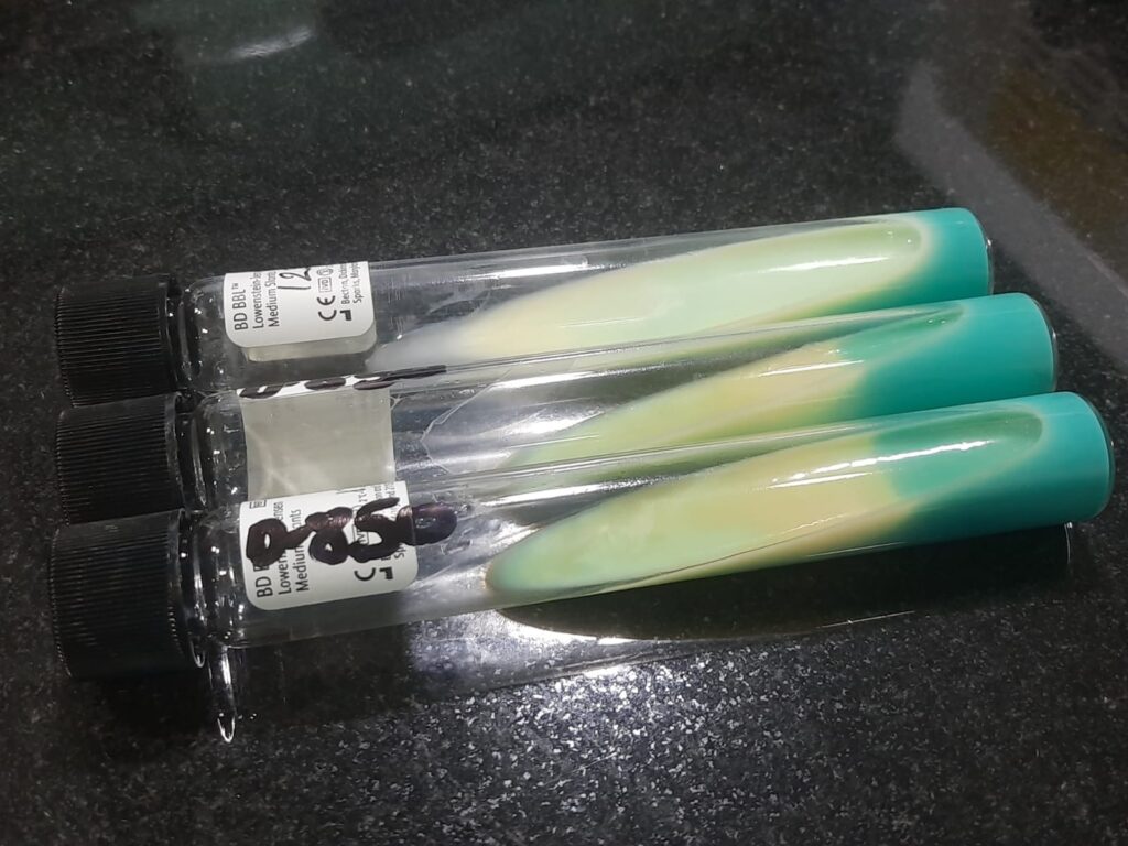 Early Medium Discoloration and Decolorization on L-J Slants: Observation-The slants show a prominent shift from the characteristic deep malachite green to a pale yellow or cream color, particularly along the center of the slants. Chemical Change- This fading of the malachite green often indicates a pH shift or enzymatic degradation of the selective agent by rapid-growing contaminants. Diagnostic Clue-While distinct colonies might not be as "fuzzy" as in fungal overgrowth, the loss of color integrity within the first week of incubation is a hallmark of culture failure. Result-These cultures should be closely monitored or flagged as contaminated, as the altered medium can no longer reliably support the growth of Mycobacterium tuberculosis.