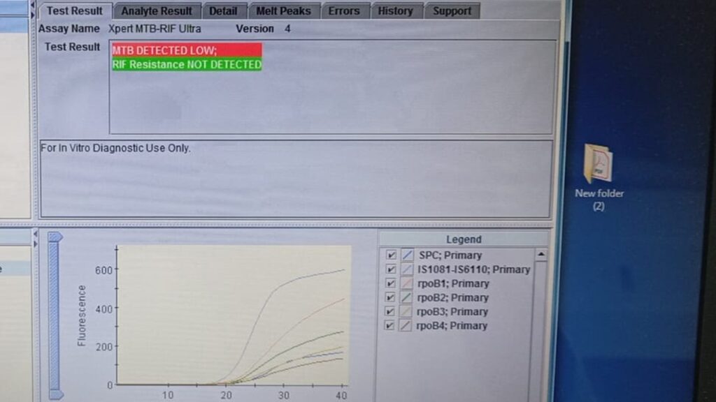 GeneXpert Dx System software interface displaying a completed diagnostic result for an Xpert MTB-RIF Ultra assay