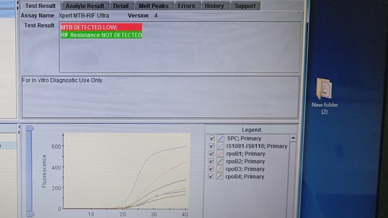 GeneXpert Dx System software interface displaying a completed diagnostic result for an Xpert MTB-RIF Ultra assay