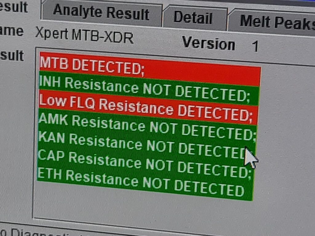 The image shows a GeneXpert software interface displaying an Xpert MTB/XDR test result with M. tuberculosis (MTB) detected and a specific drug resistance profile.Key Findings:MTB DETECTED: Positive for Mycobacterium tuberculosis complex.Low FLQ Resistance DETECTED: Indicates low-level resistance to fluoroquinolones (e.g., levofloxacin or moxifloxacin).Resistance NOT DETECTED: No mutations were found for isoniazid (INH), amikacin (AMK), kanamycin (KAN), capreomycin (CAP), or ethionamide (ETH).This result is consistent with a pre-XDR-TB diagnosis, as there is resistance to fluoroquinolones but susceptibility to second-line injectables.