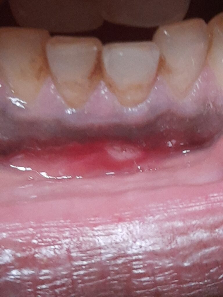 Red Sore on Inner Lip