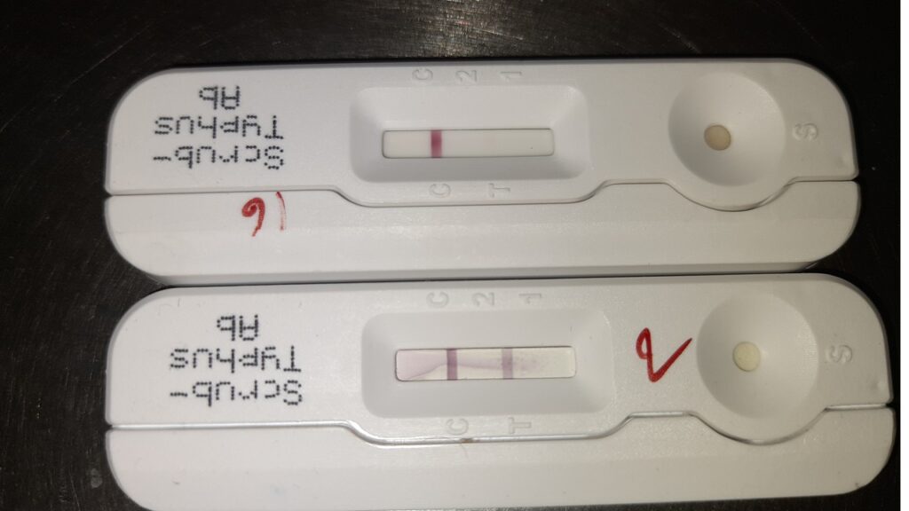 Scrub Typhus (Orientia tsutsugamushi) Rapid Test positive and negative results