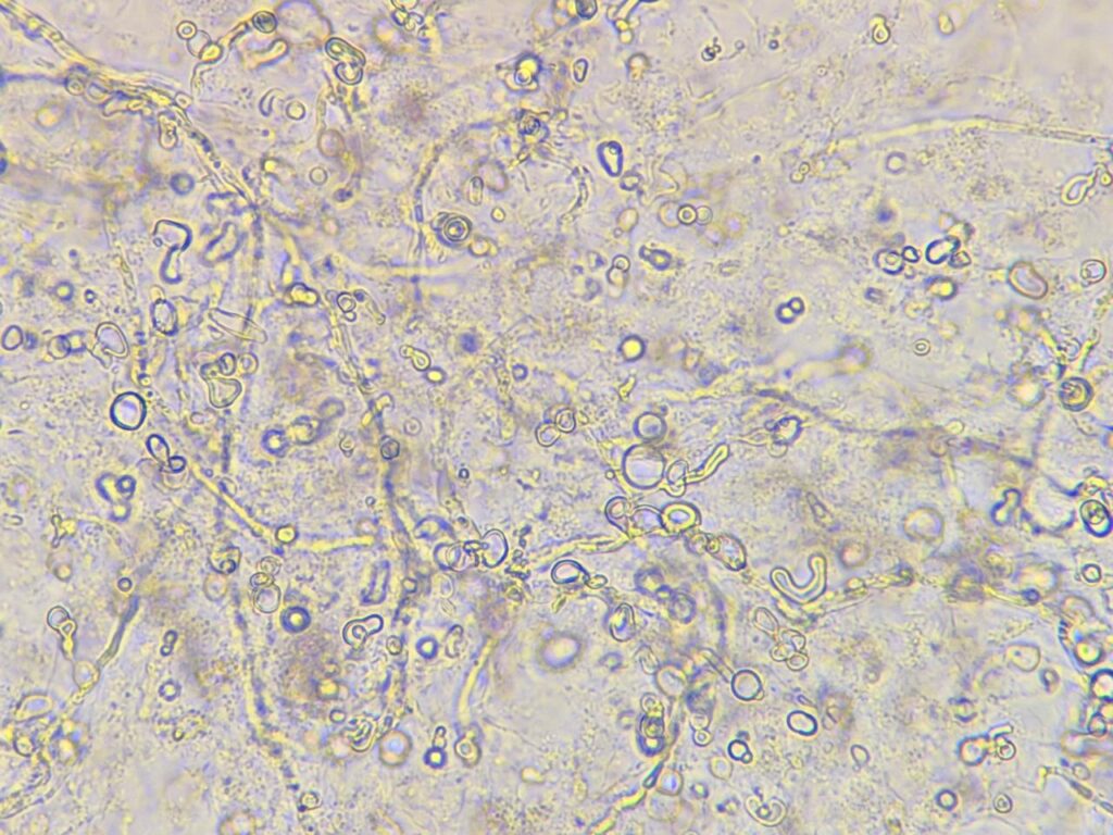 Branched septate fungal hyphae in KOH mount of nail clipping at a magnification of 1000x with 4x optical zoom