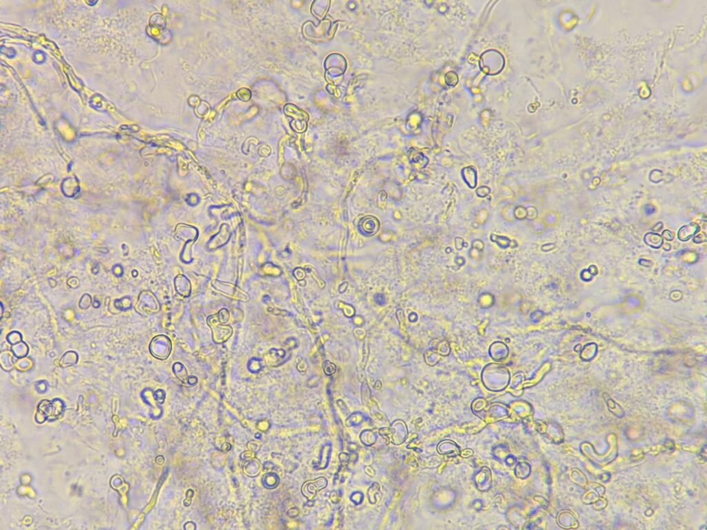 Branching funal hyphae in KOH mount of nail clipping at a magnification of 1000x with 4x optical zoom