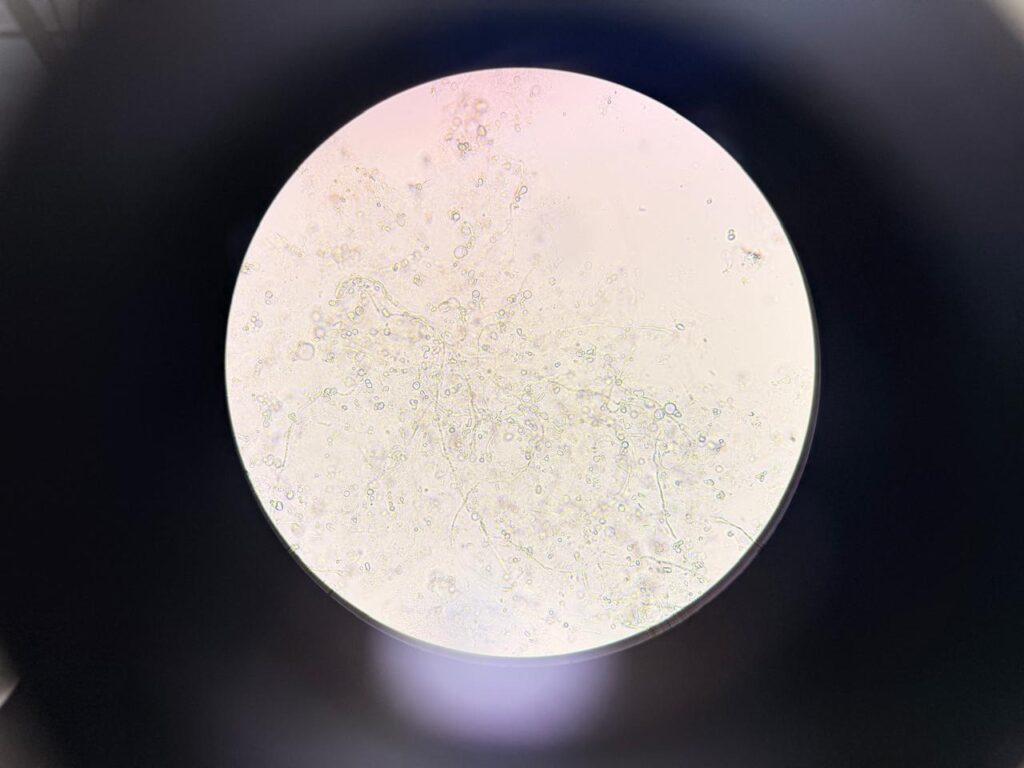 Fungal element in KOH mount of nail clipping at a magnification of 1000x