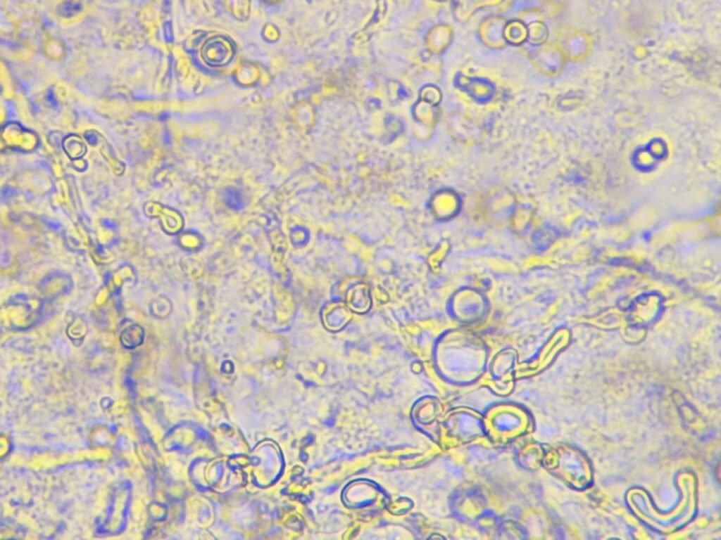 Fungal element in KOH mount of nail clipping at a magnification of 1000x with 8x optical zoom