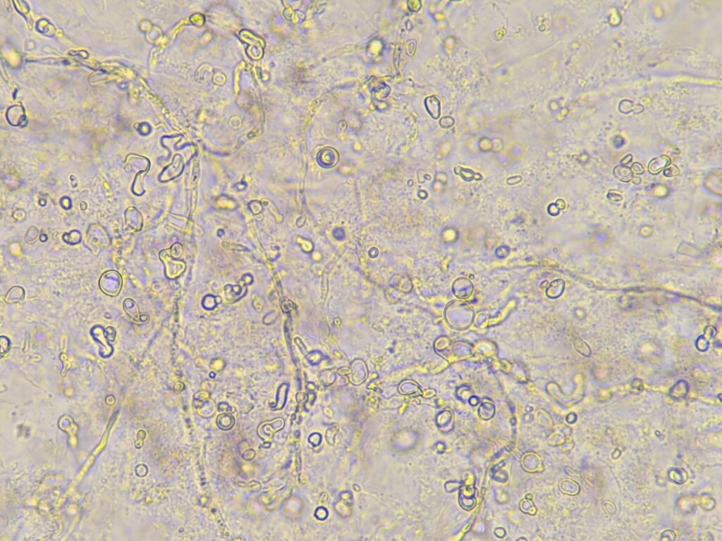 Fungal hyphae in KOH mount of nail clipping at a magnification of 1000x with 2x optical zoom