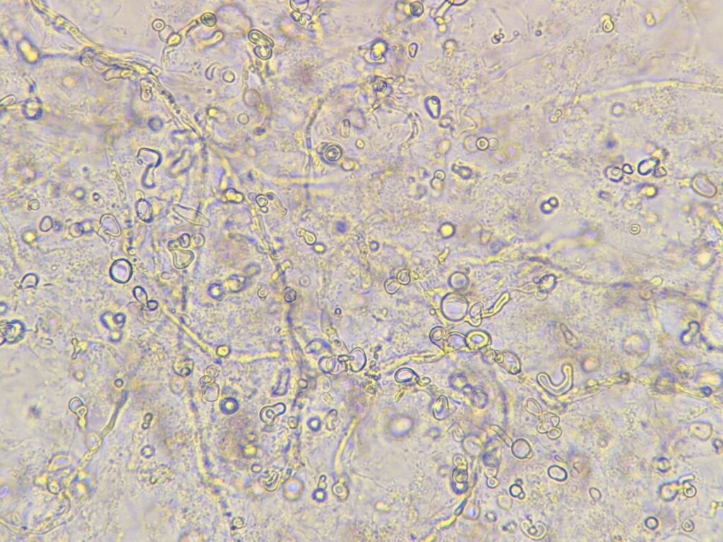 Fungal hyphae in KOH mount of nail clipping at a magnification of 1000x with 4x optical zoom