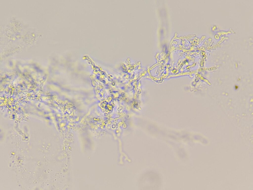 Hyaline branched septate fungal hyphae in KOH mount of nail clipping at a magnification of 1000x with 4x optical zoom