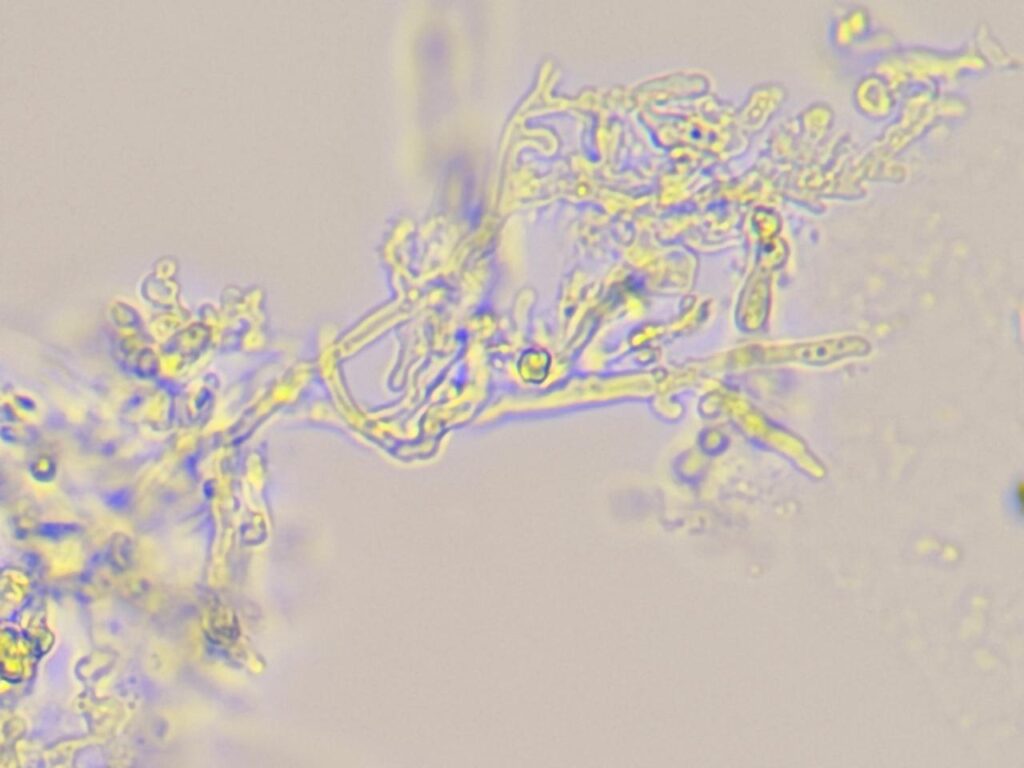Hyaline branched septatae fungal hyphae in KOH mount of nail clipping at a magnification of 1000x with 8x optical zoom