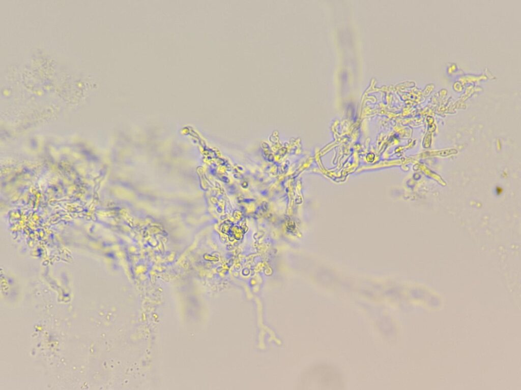 Hyaline branching septate fungal hyphae in KOH mount of nail clipping at a magnification of 1000x with 4x optical zoom