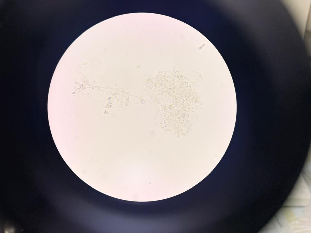 Hyaline septatae fungal hyphae in KOH mount of nail clipping at a magnification of 1000x