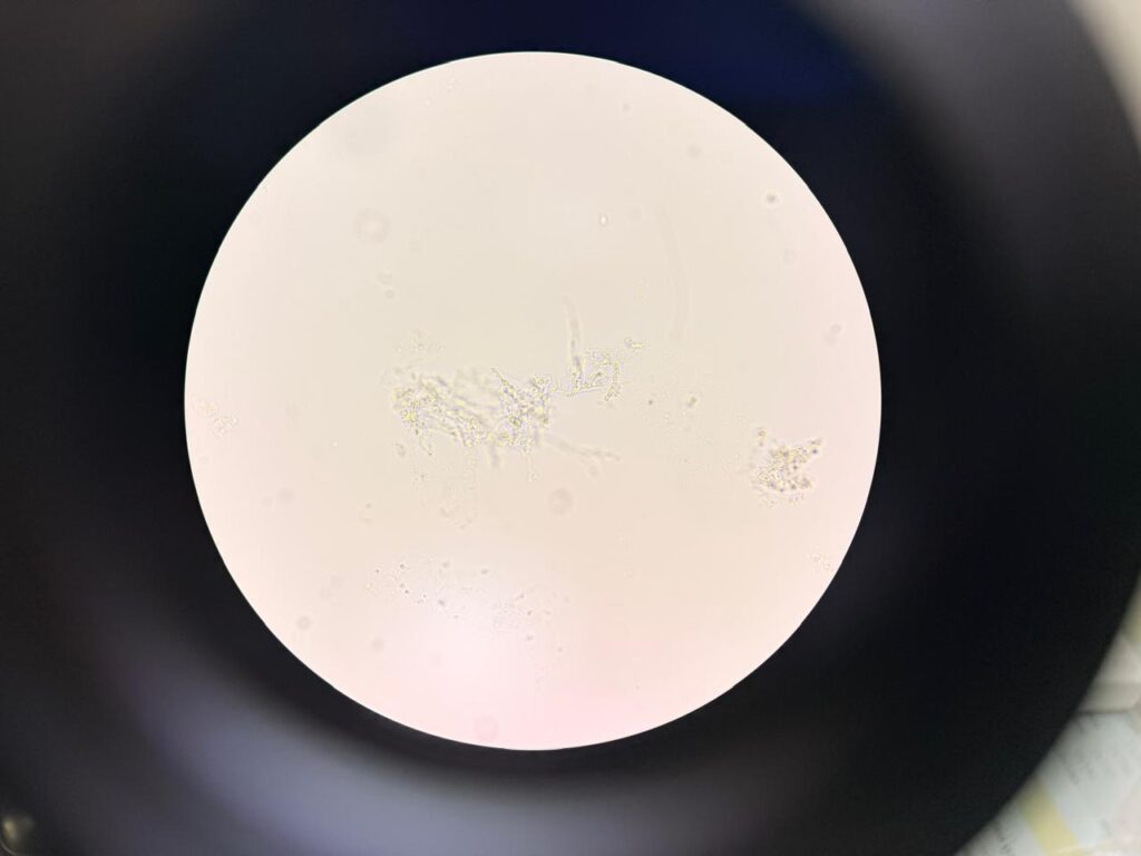 Hyaline septate fungal hyphae in KOH mount of nail clipping at a magnification of 1000x
