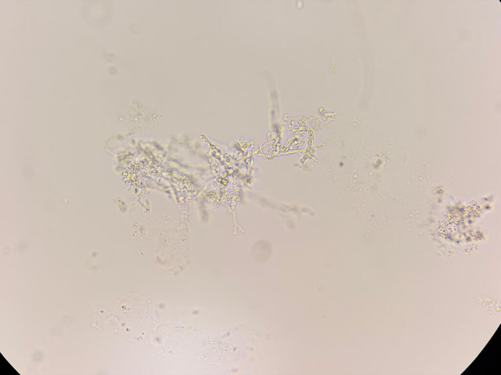  Hyaline septate fungal hyphae in KOH mount of nail clipping at a magnification of 1000x with 2x optical zoom