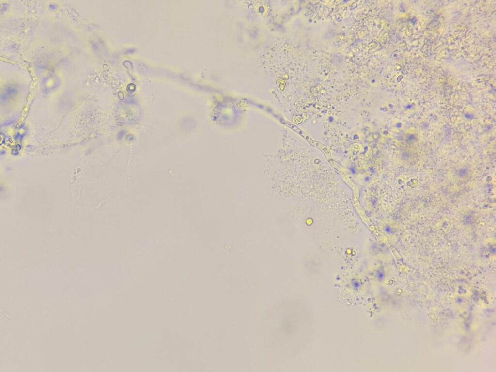 Hyaline septatae fungal hyphae in KOH mount of nail clipping at a magnification of 1000x with 4x optical zoom