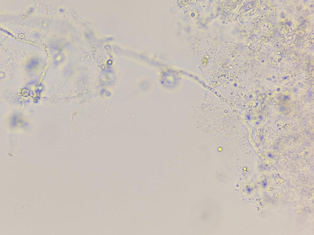 Hyaline septatae fungal hyphae in KOH mount of nail clipping at a magnification of 1000x with 4x optical zoom-