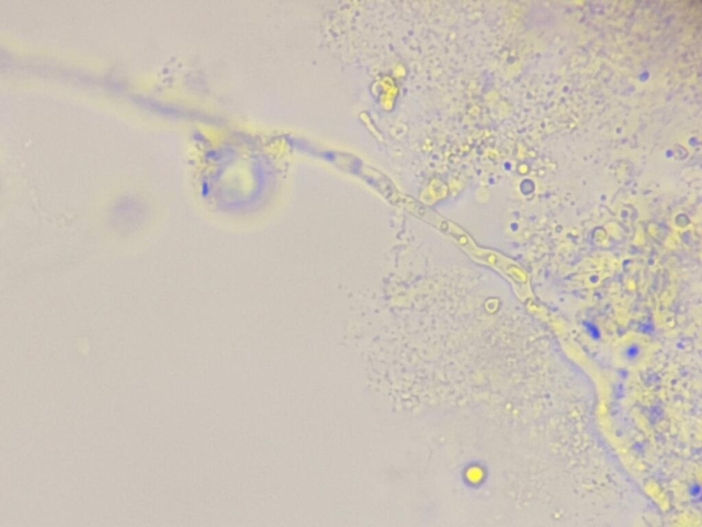 Hyaline septate fungal hyphae in KOH mount of nail clipping at a magnification of 1000x with 8x optical zoom