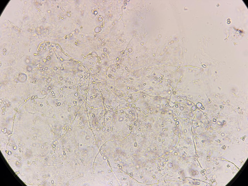 Septatae fungal hyphae in KOH mount of nail clipping at a magnification of 1000x with 2x optical zoom