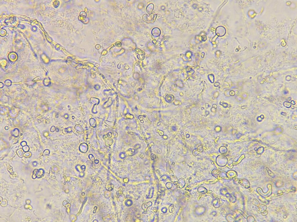 Septate fungal hyphae in KOH mount of nail clipping at a magnification of 1000x with 4x optical zoom