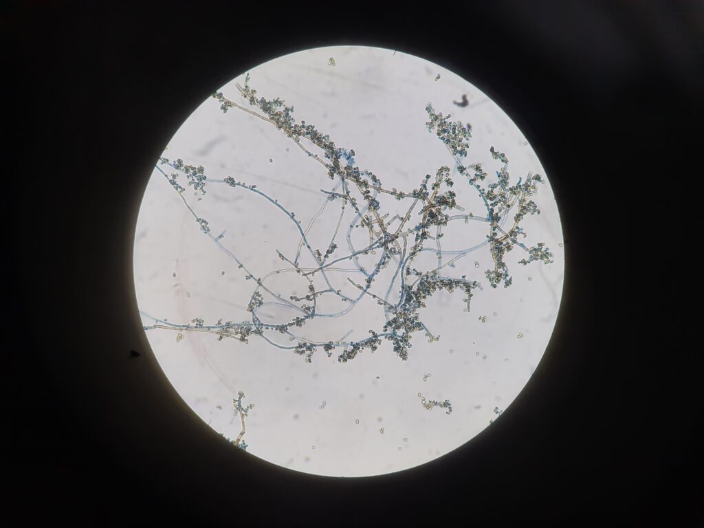 LPCB mount (400x) showing Cladophialophora species- Dematiaceous, septate hyphae producing long, branching, intact chains of oval conidia