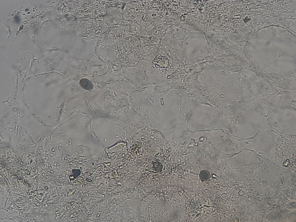 Sclerotic bodies of Cladophialophora in KOH mount of clinical specimen at a magnifixation of 400x with 4x optical zoom