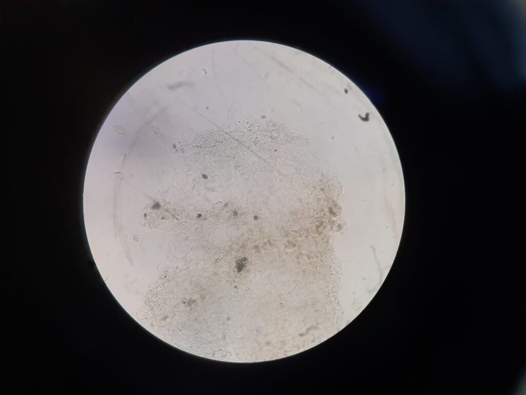 Sclerotic bodies of Cladophialophora in KOH mount of skin scraping at a magnifixation of 400x